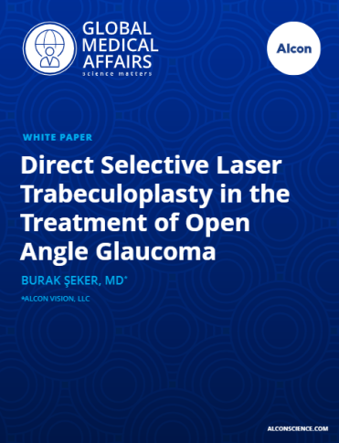 Direct Selective Laser Trabeculoplasty in the Treatment of Open Angle Glaucoma Direct Selective Laser Trabeculoplasty in the Treatment of Open Angle Glaucoma