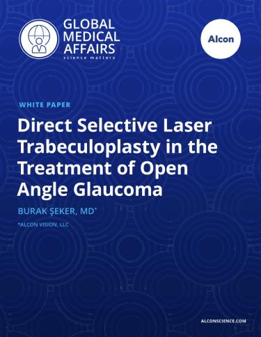 Direct Selective Laser Trabeculoplasty in the Treatment of Open Angle Glaucoma