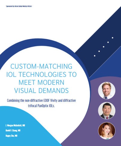 Custom-matching IOL technologies to meet modern visual demands. Combining the non-diffractive EDOF Vivity and diffractive trifocal PanOptix IOLs.